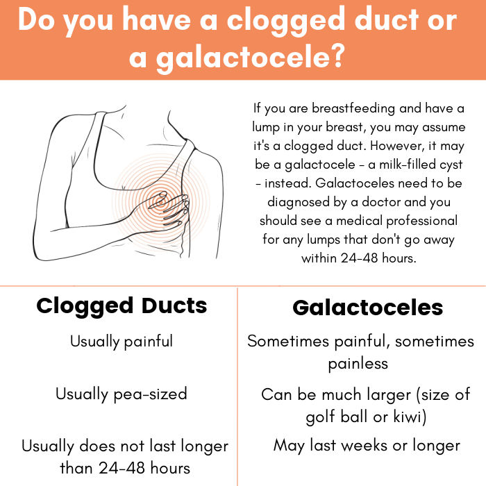 illustration of woman holding breast with circles radiating out of the breast indicating pain with text overlay Do You Have a Clogged Duct or a Galactocele? If you are breastfeeding and have a lump in your breast, you may assume it's a clogged duct, However, it may be a galactocele - a milk-filled cyst - instead. Galactoceles need to be diagnosed by a doctor and you should see a medical professional for any lumps that don't go away within 24-48 hours. Clogged ducts: Usually painful, usually pea-sized, usually do not last longer than 24-48 hours | Galactoceles Sometimes painful, can be much larger (size of golf ball or kiwi), may last weeks or longer