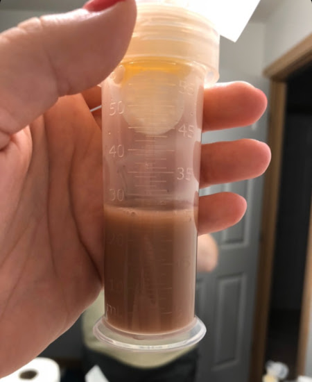 Brown Breastmilk: Brown breast milk in a small bottle