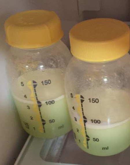 Green Breastmilk: Green breast milk in two Medela bottles