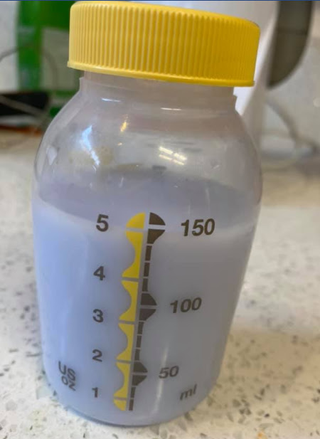 Purple Breastmilk: Purple breast milk in a Medela bottle