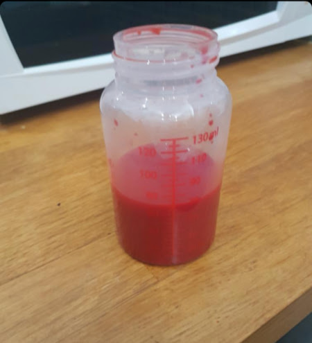 Red breastmilk: Red breastmilk in a baby bottle