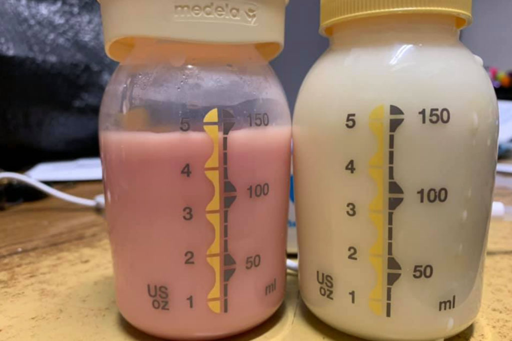 Bottle of breast milk with blood on it next to a bottle of normal breast milk