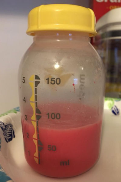 red breast milk (breast milk with blood in it) in a Medela bottle